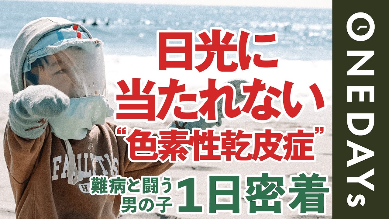 【寿命は約20〜30歳】日光に当たれない難病の男の子に1日密着してみた