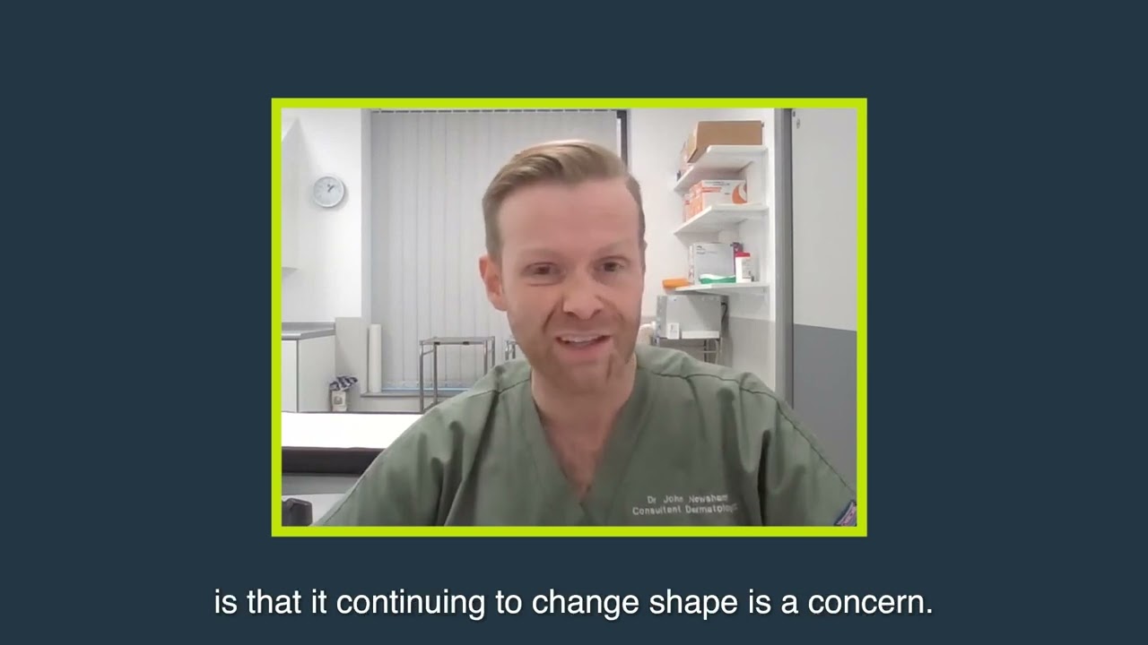 Skin cancer – Assessing colour, shape & size