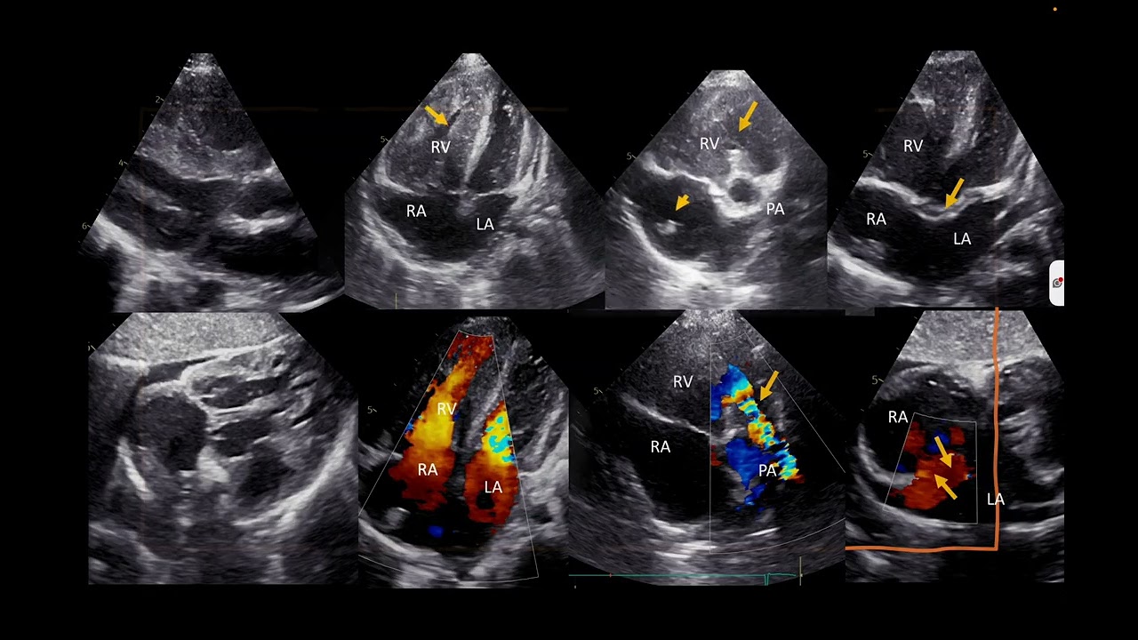 Echo of Adult Congenital Heart Disease case with common, uncommon and rare findings