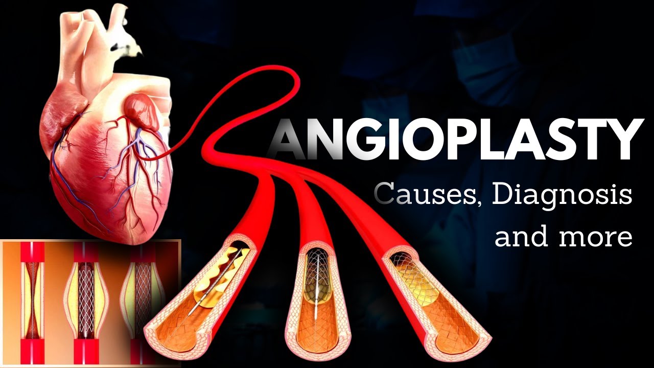 Angioplasty, Causes, Signs and Symptoms, Diagnosis and Treatment.