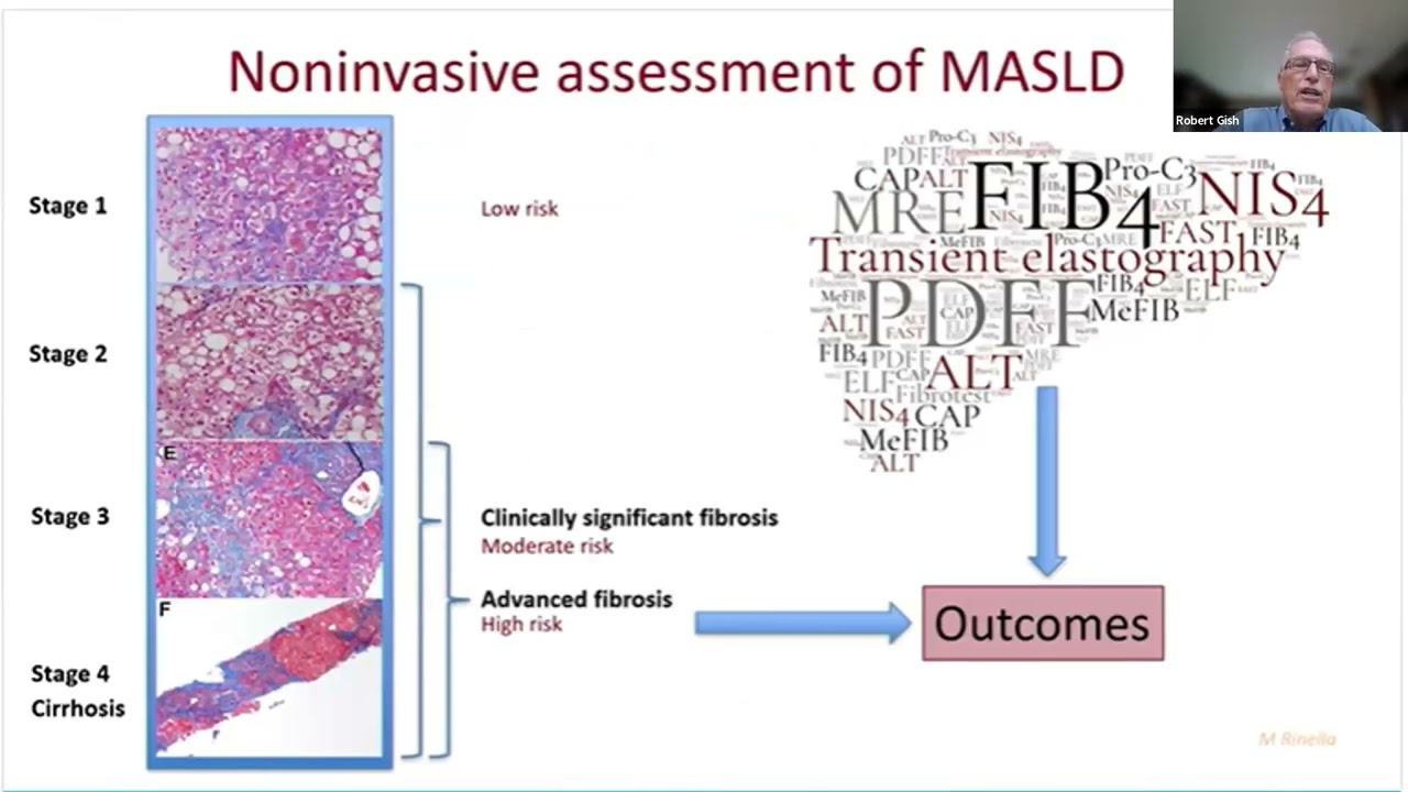 MAFLD MASLD NASH ......