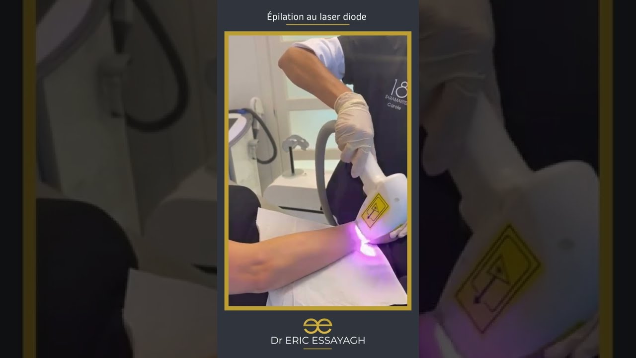 L'épilation au laser diode présentée par le Dr Eric Essayagh sur Antibes