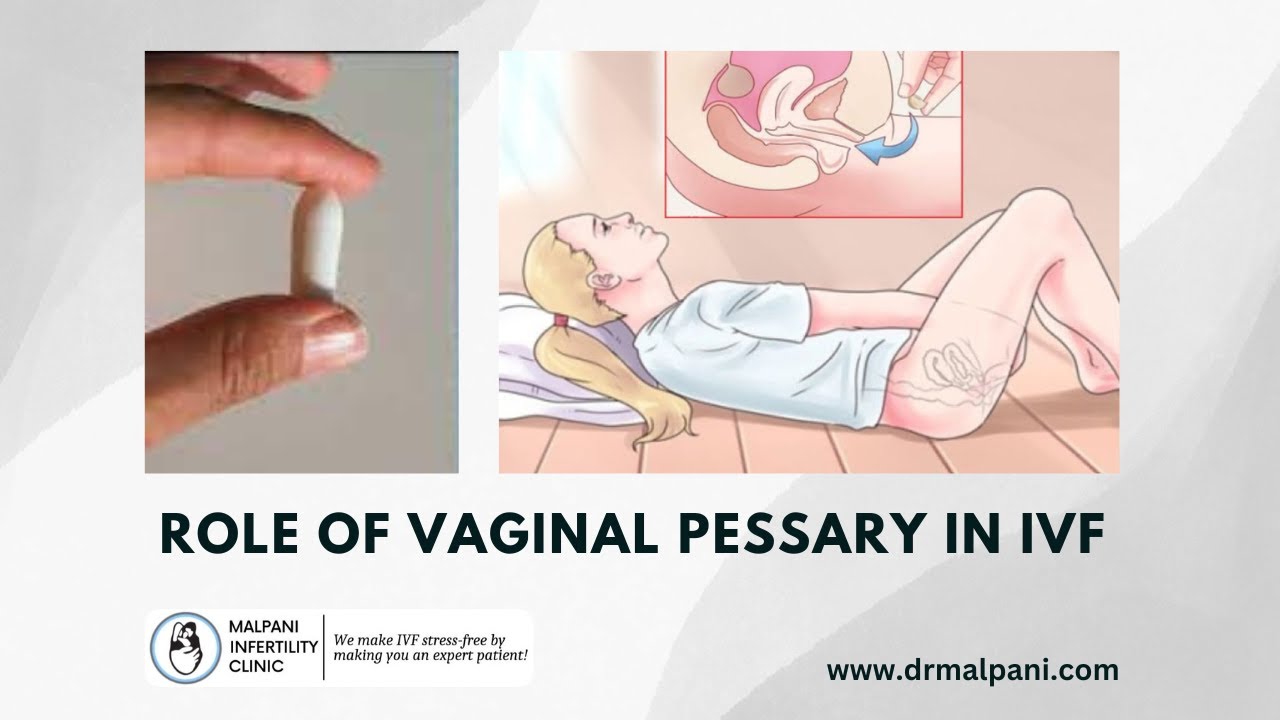 Role of Vaginal Pessaries in IVF Treatment