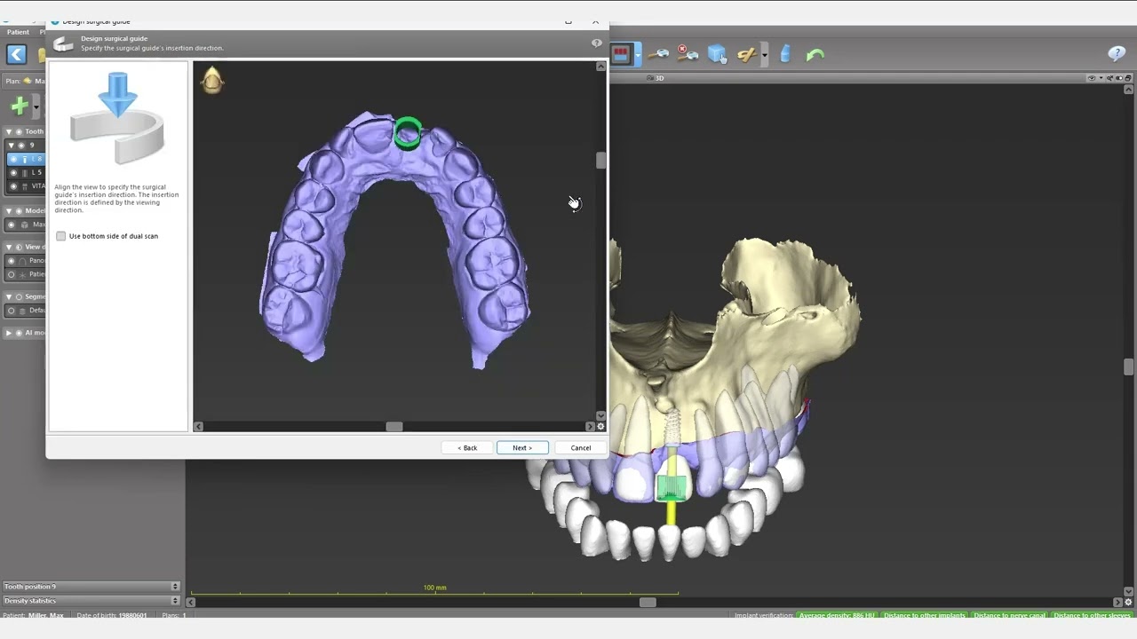 Straumann coDiagnostix Single Implant Guide with AI Assistant