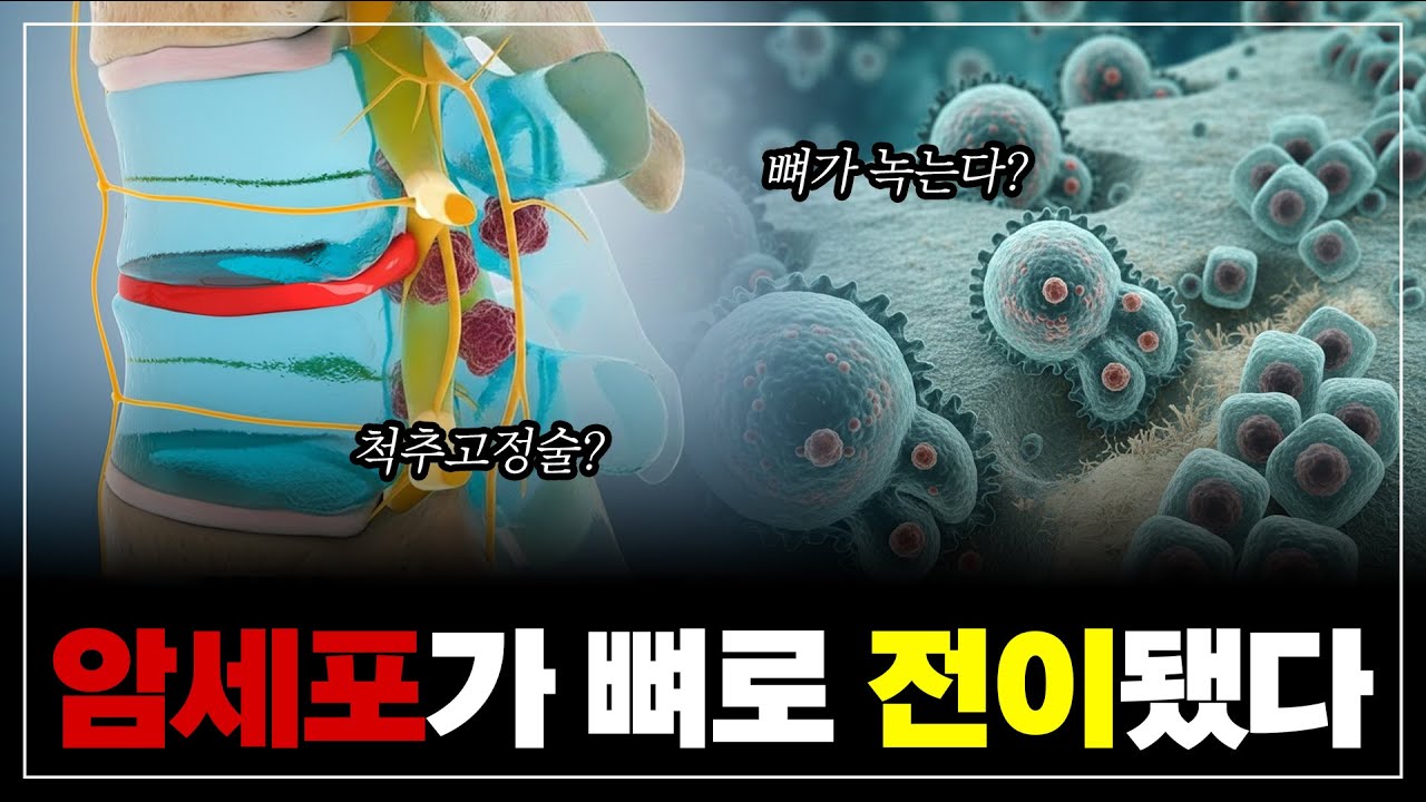 암 진단 이후, 뼈 전이! 언제 가장 주의해야 할까?
