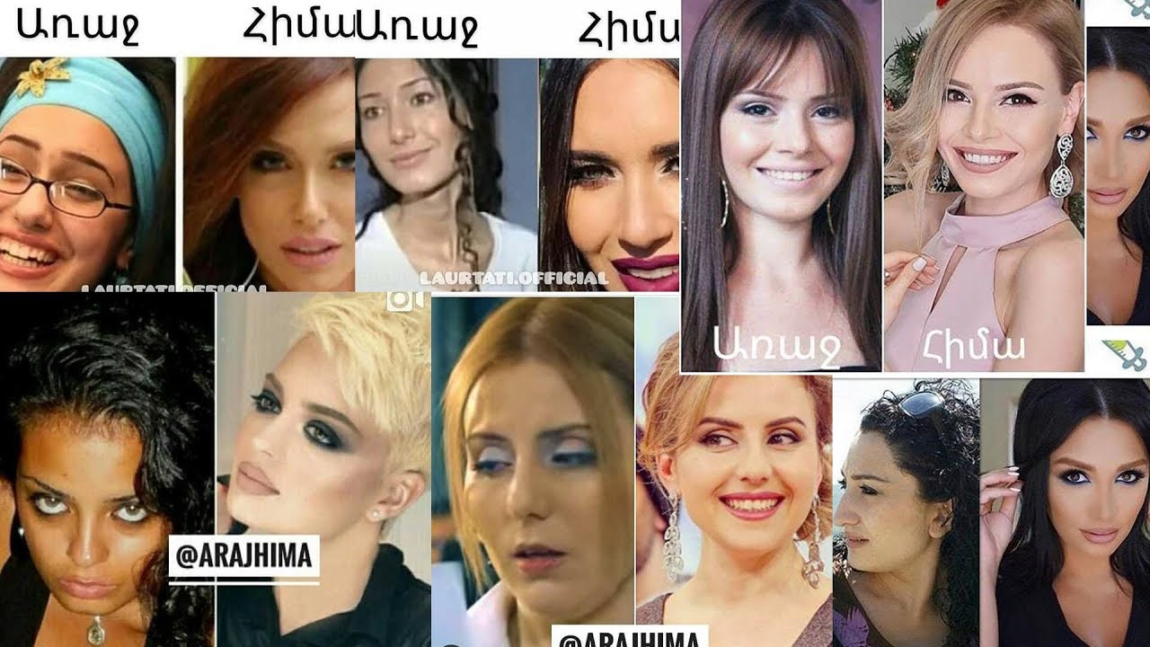 Հայ հայտնիներ ովքեր դիմել են պլաստիկ վիրահատության եւ դարձել են իսկական գեղեցկուհիներ: