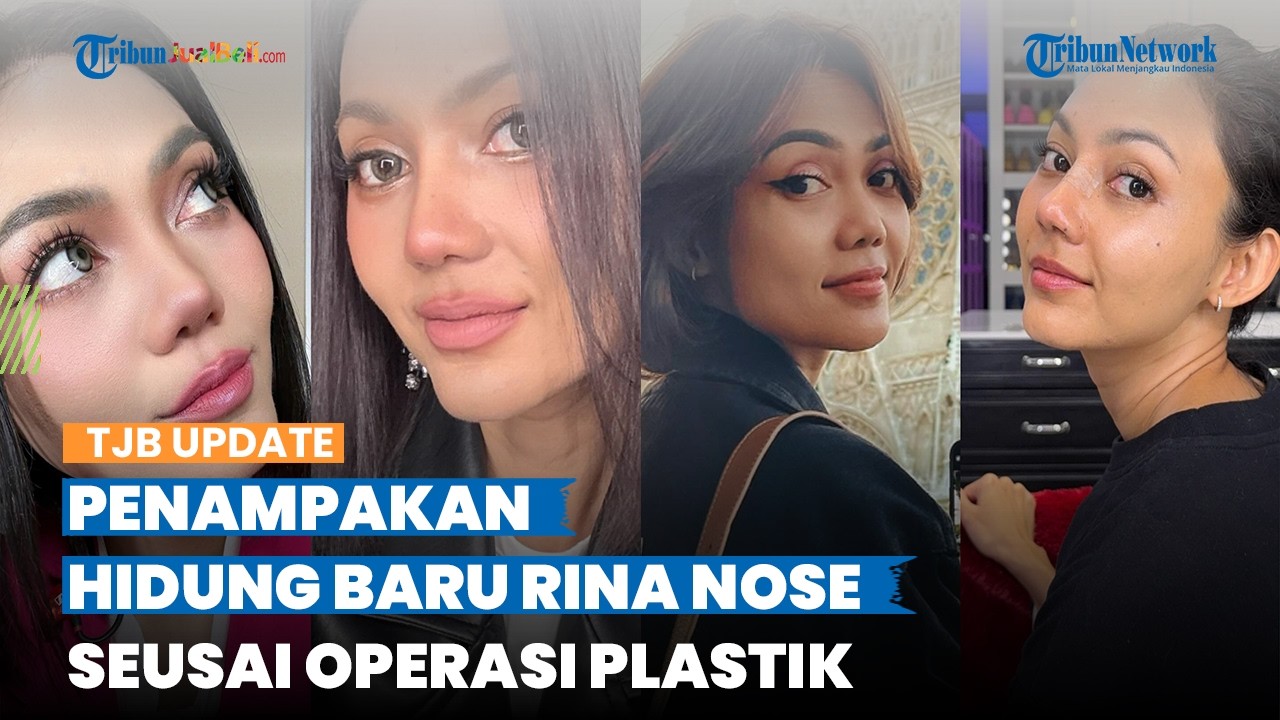 Wajahnya Disebut Manglingi, Intip Penampakan Hidung Baru Rina Nose seusai Operasi Plastik