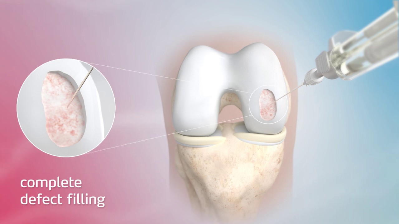 ChondroFiller liquid implant for Cartilage regeneration