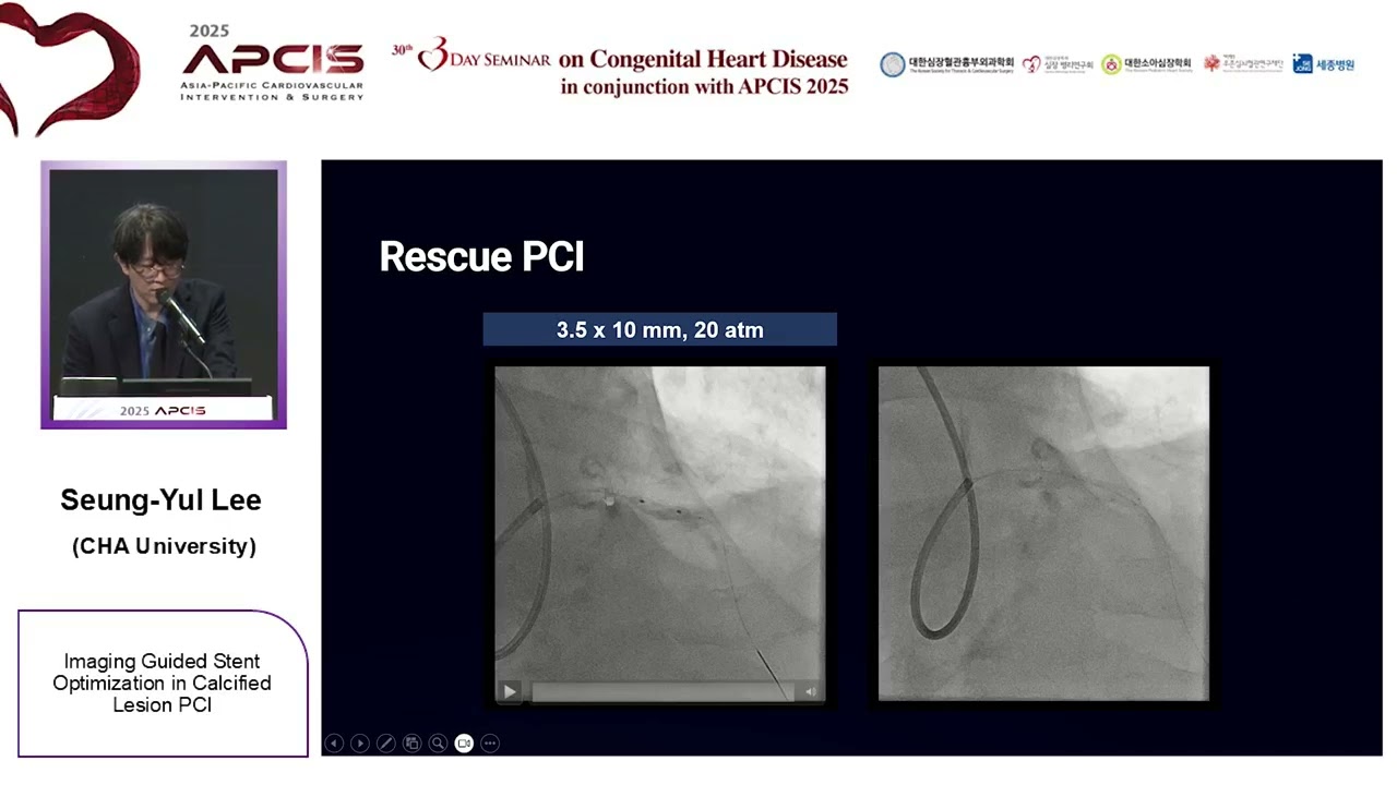 Imaging Guided Stent Optimization in Calcified Lesion PCI