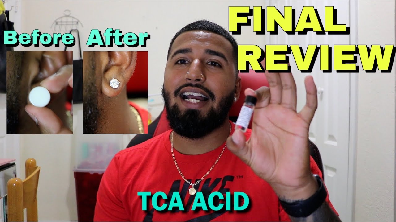 FINAL REVIEW Closing My Stretched Ears With TCA Acid | NO SURGERY