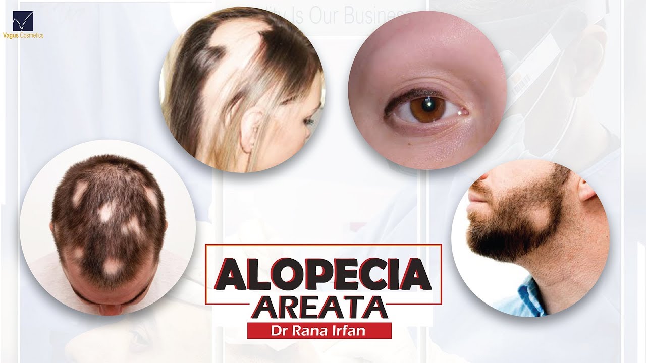Alopecia Areata | Patchy Hair Loss in Men & Women | Autoimmune Hair Loss
