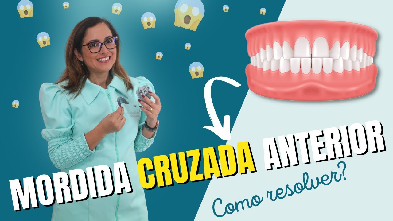 Mordida Cruzada Anterior  - Como resolver? Adornare Odontologia Estética em Santos