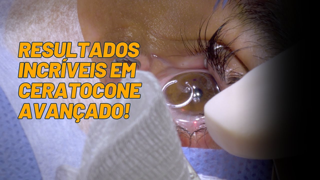 Ceratocone Avançado? 👁️ De 25 Graus de Miopia para 7 com Anel Corneano!