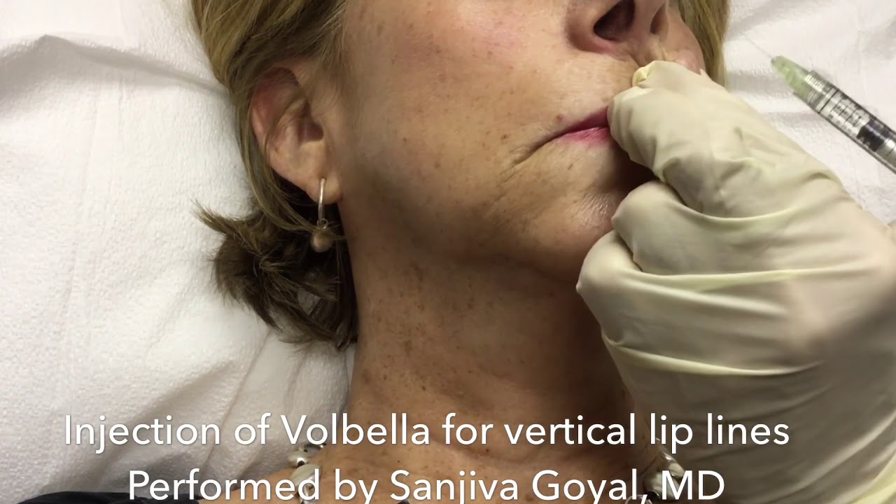 Injection of Volbella for vertical lip lines