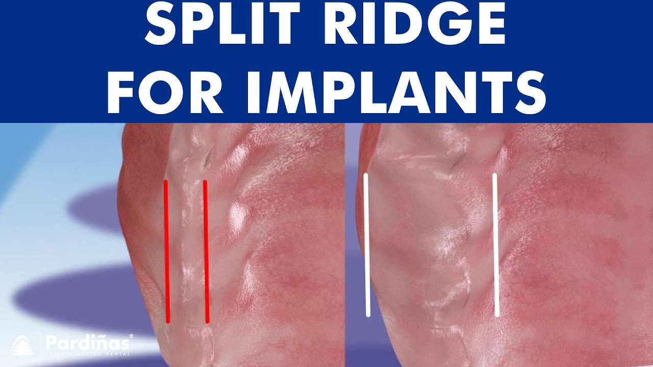 ALVEOLAR RIDGE EXPANSION - Dental implant placement with bone ridge splitting &copy;