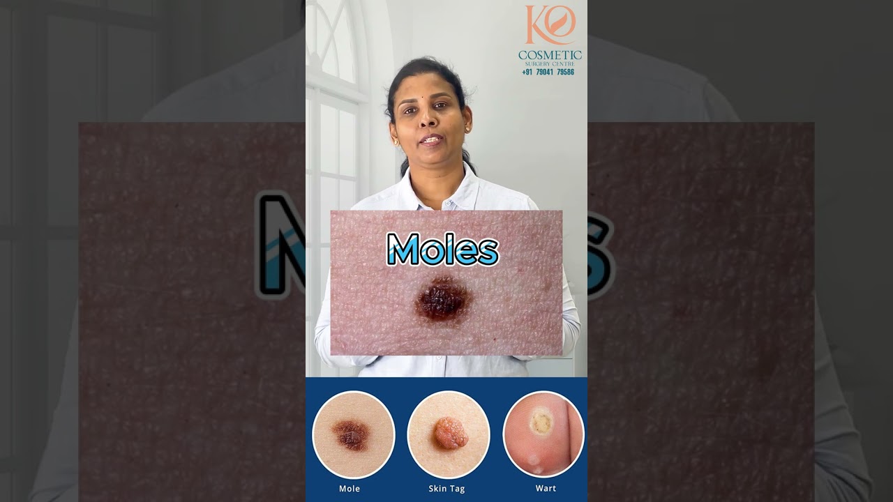 Removing Moles and Skin Tags |   Dr. Kovarthini Cosmetic and Plastic Surgeon