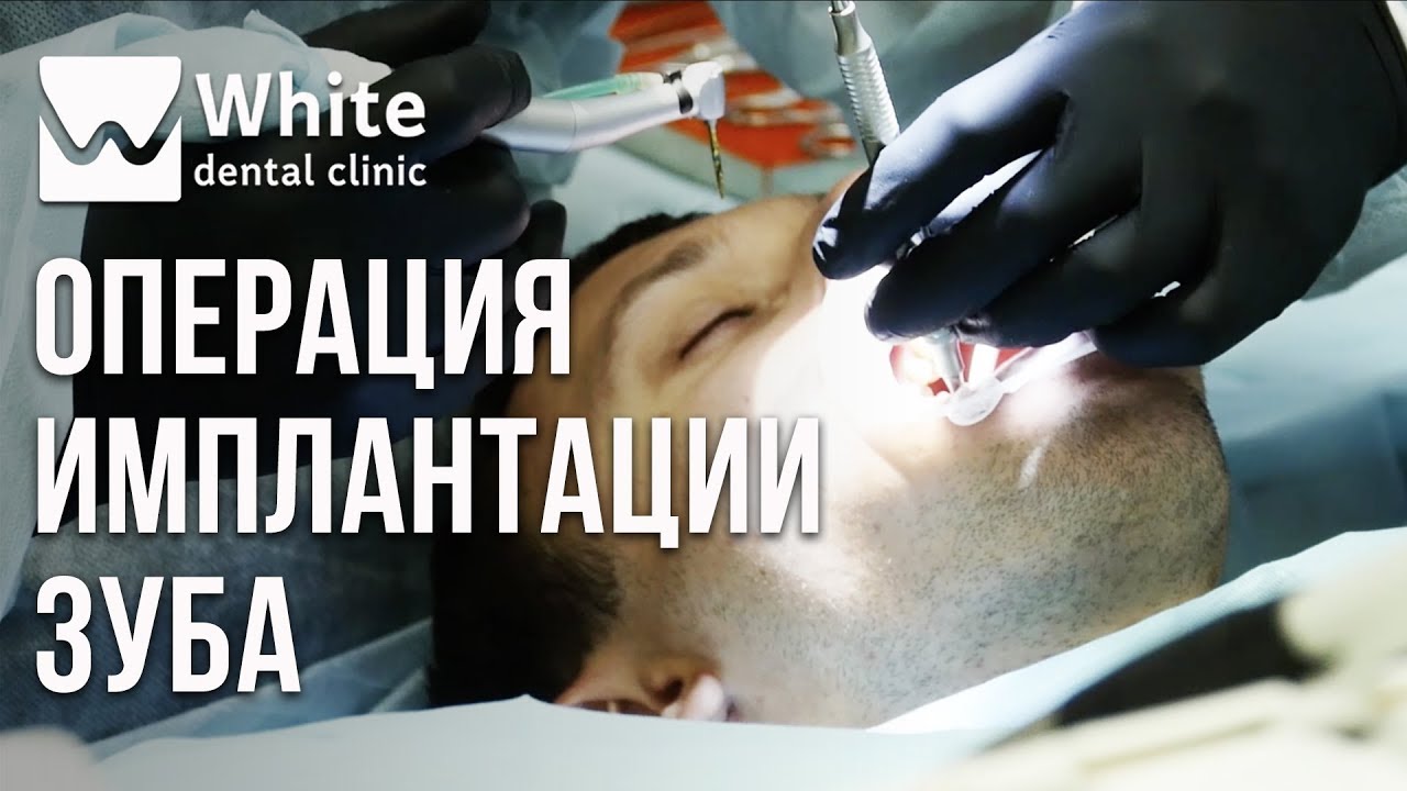 Реальная операция -  имплантация зуба. Установка имплантата по шаблону