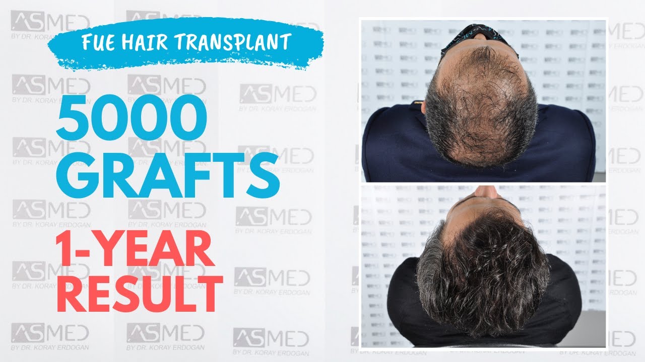 Manual FUE Hair Transplant Before & After 5000 Grafts 1-Year Result - ASMED - Dr. Koray Erdogan