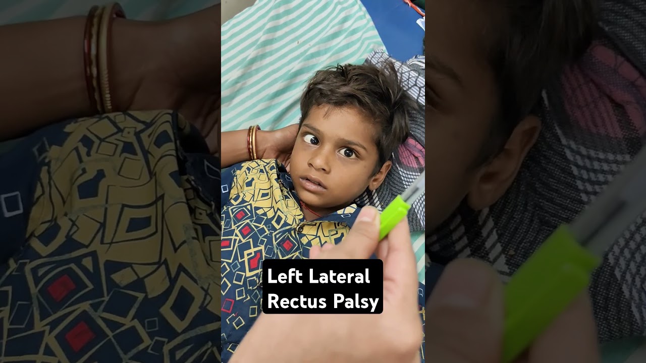 left lateral rectus palsy in a patient of GBS #medicalshorts #neurology #picu