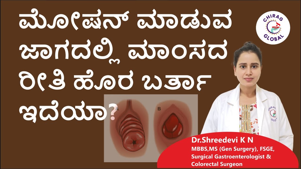ಗುದಭಾಗದಲ್ಲಿ ಹೊರಬರುತ್ತಿರುವ  ಮಾಂಸ  📞8867546900 | Dr. Shreedevi K N | Chirag Global Hospital