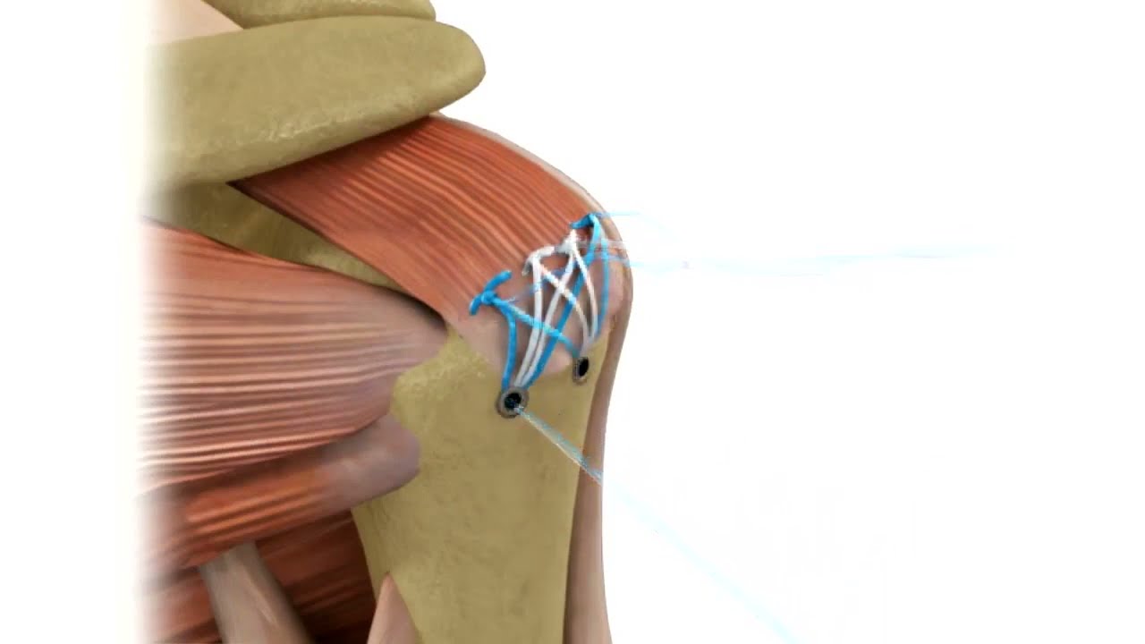 Reparaci&oacute;n de Manguito Rotador con Ancla Juggerknot 2.9mm de Zimmer Biomet