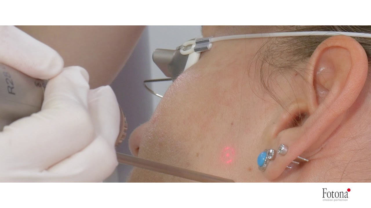 Fotona StarWalker Pigment Removal