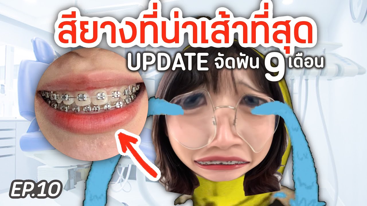 🦷UPDATE🦷สียางที่น่าเส้าที่สุด;( อัพเดทจัดฟัน 9 เดือน EP.10 (มีอีีกฮอฟฟ) | SOMz