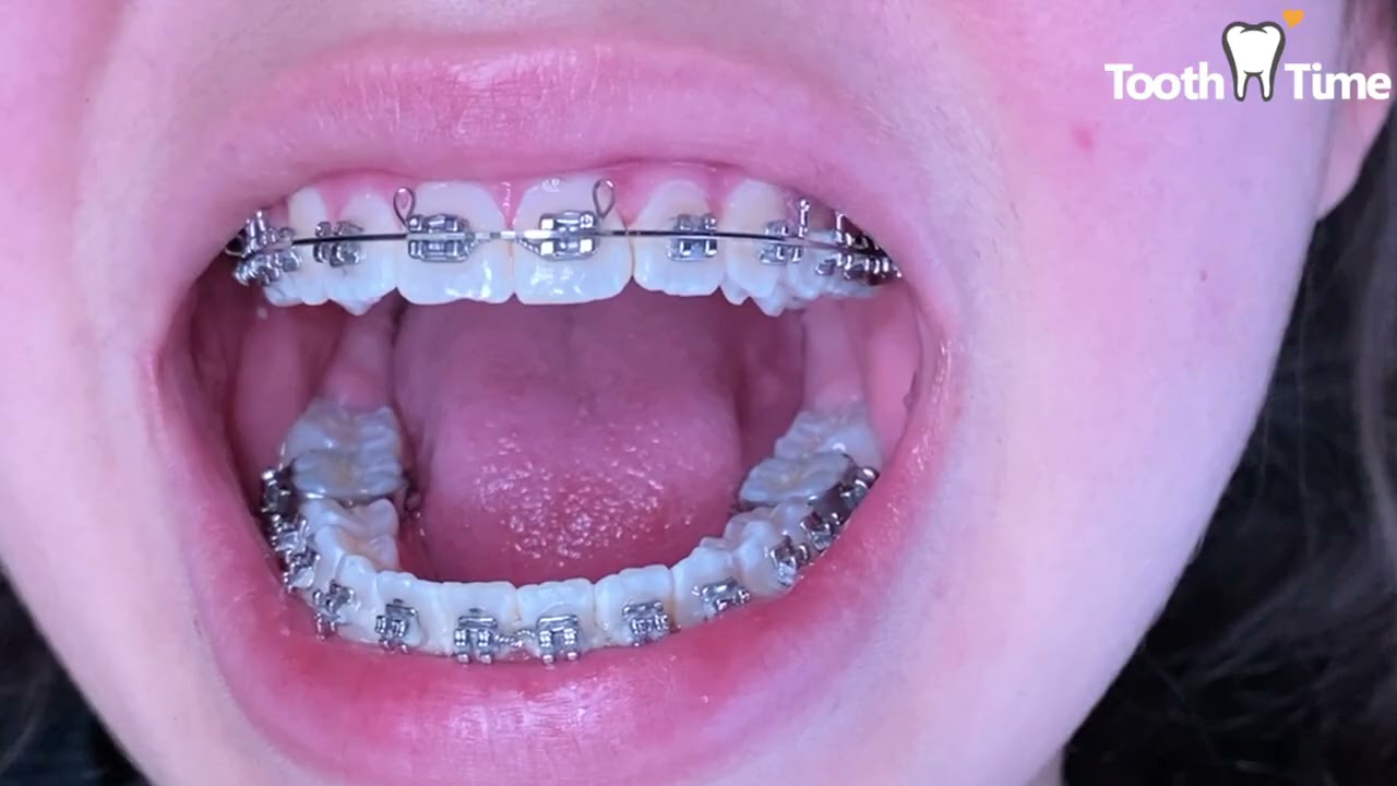 Braces Checkups - 1 year progress - Tooth Time Family Dentistry New Braunfels