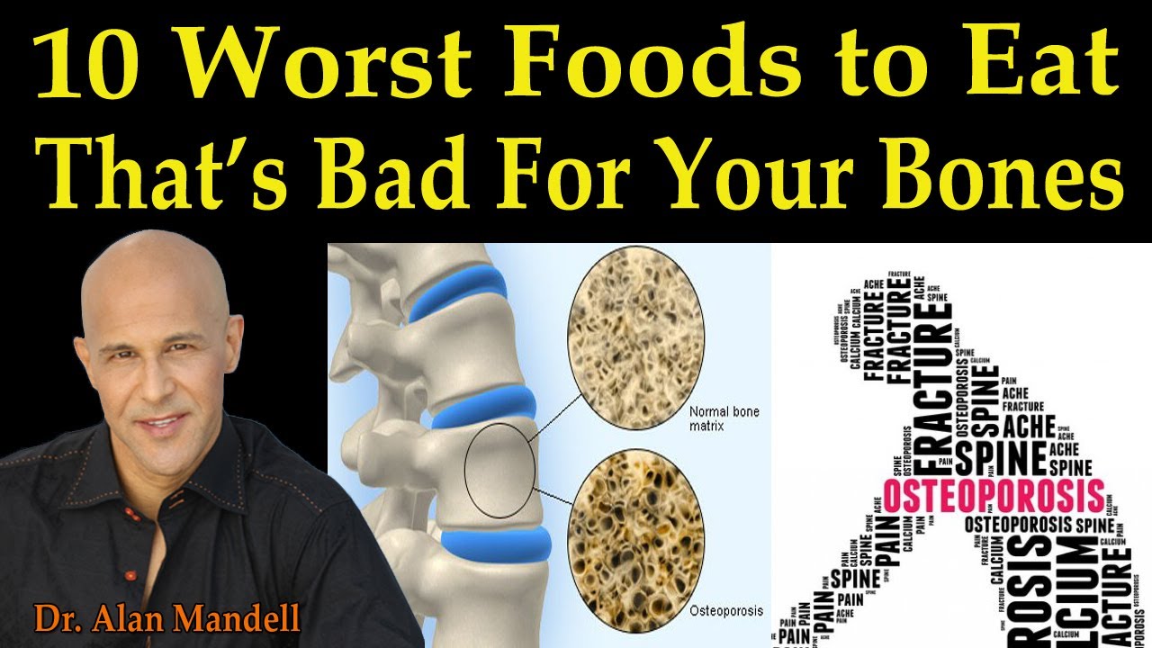 10 Worst Foods to Eat That's Bad for Your Bones (Osteoporosis) - Dr. Alan Mandell, D.C.