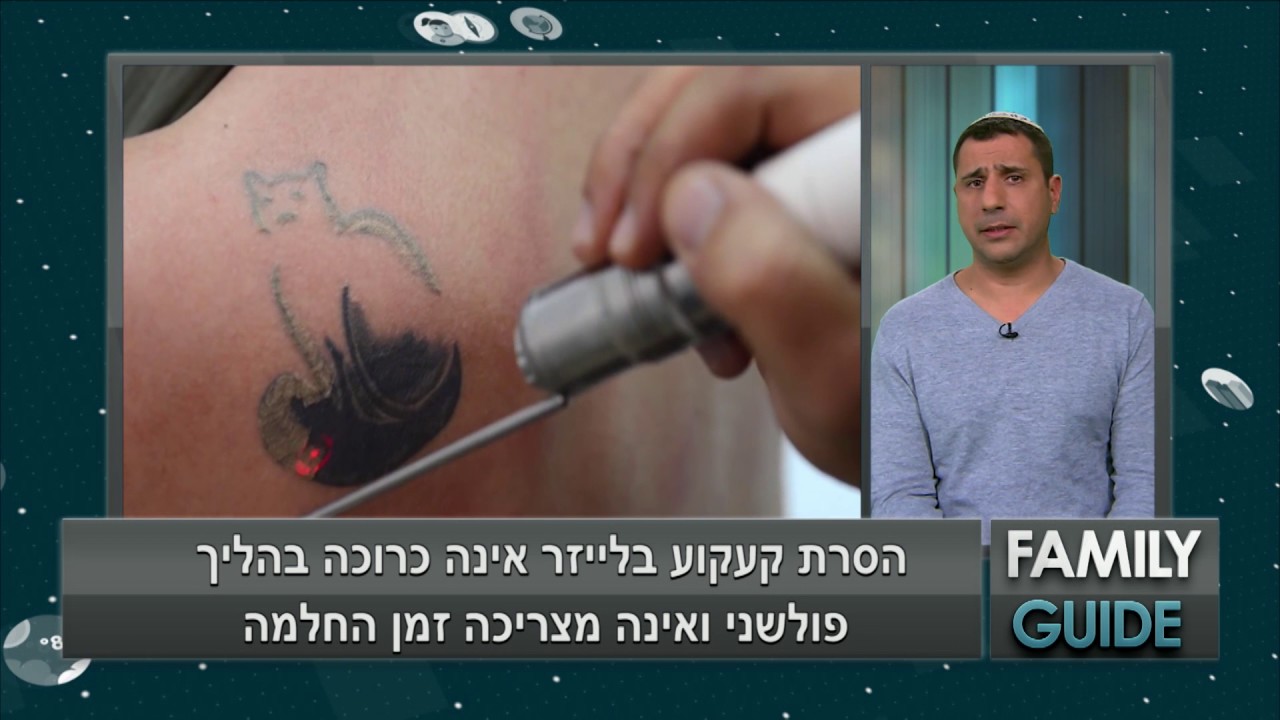 טופ לייזר הסרת קעקועים - Family Guide