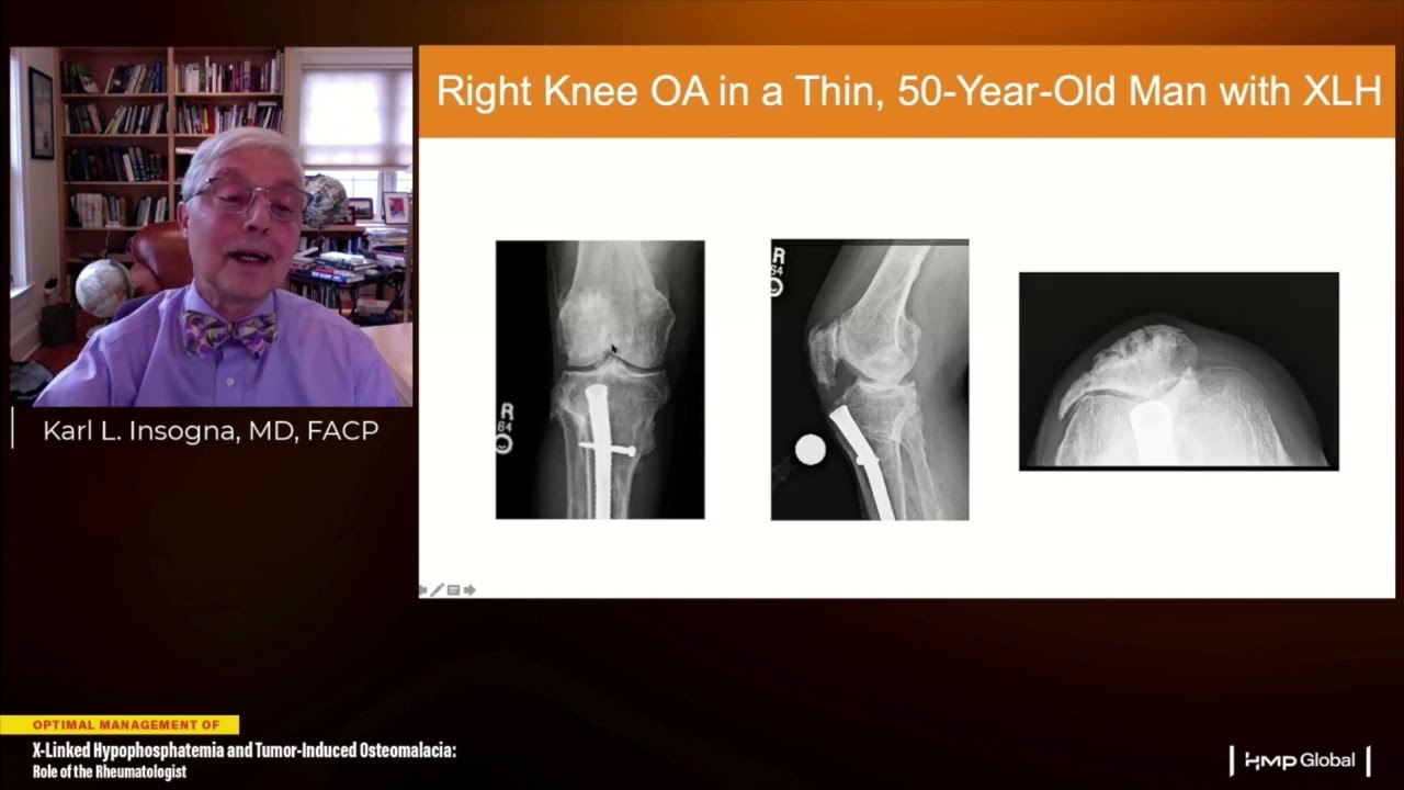 Optimal Management of X-Linked Hypophosphatemia and Tumor-Induced Osteomalacia