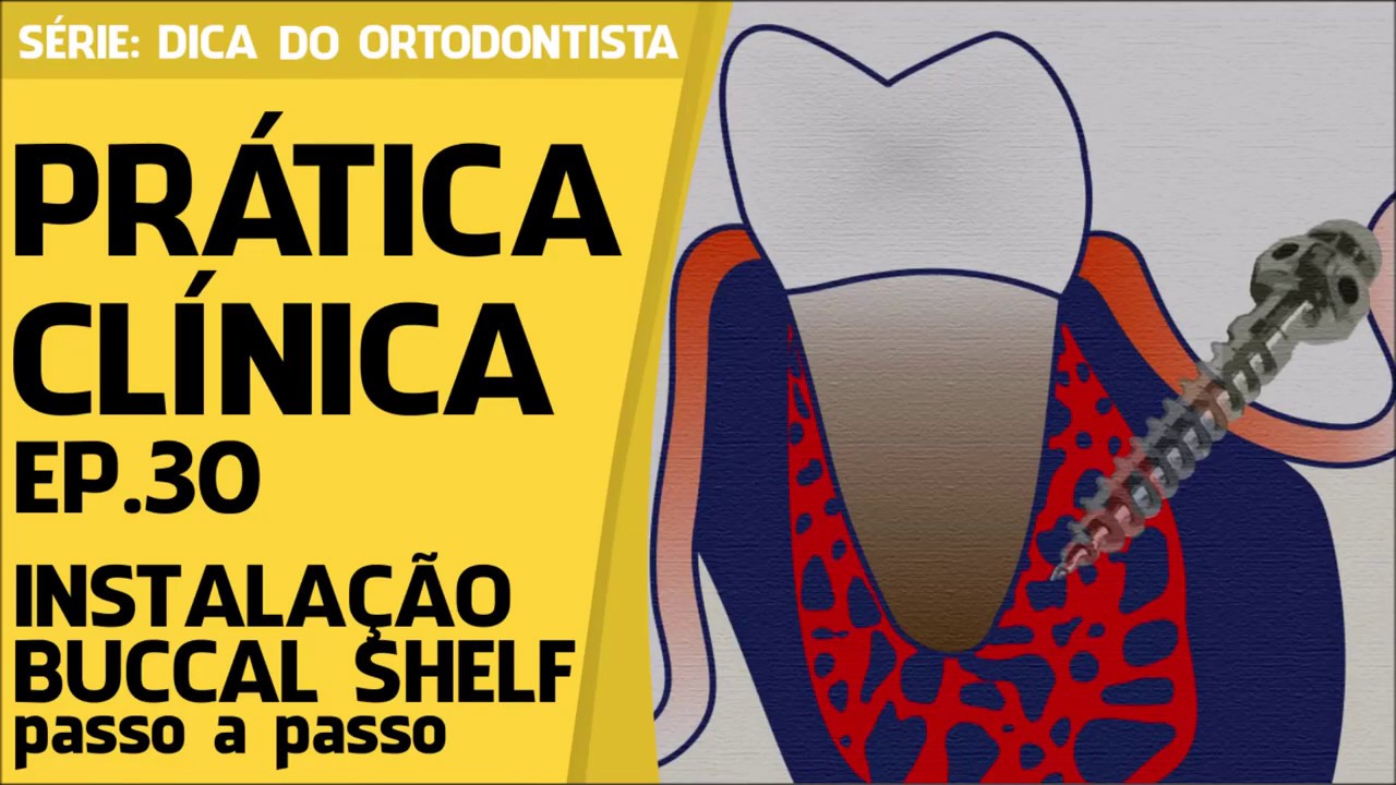 COMO INSTALAR O BUCCAL SHELF? I PASSO A PASSO I EP. 30 I PROF. RODRIGO MILANI