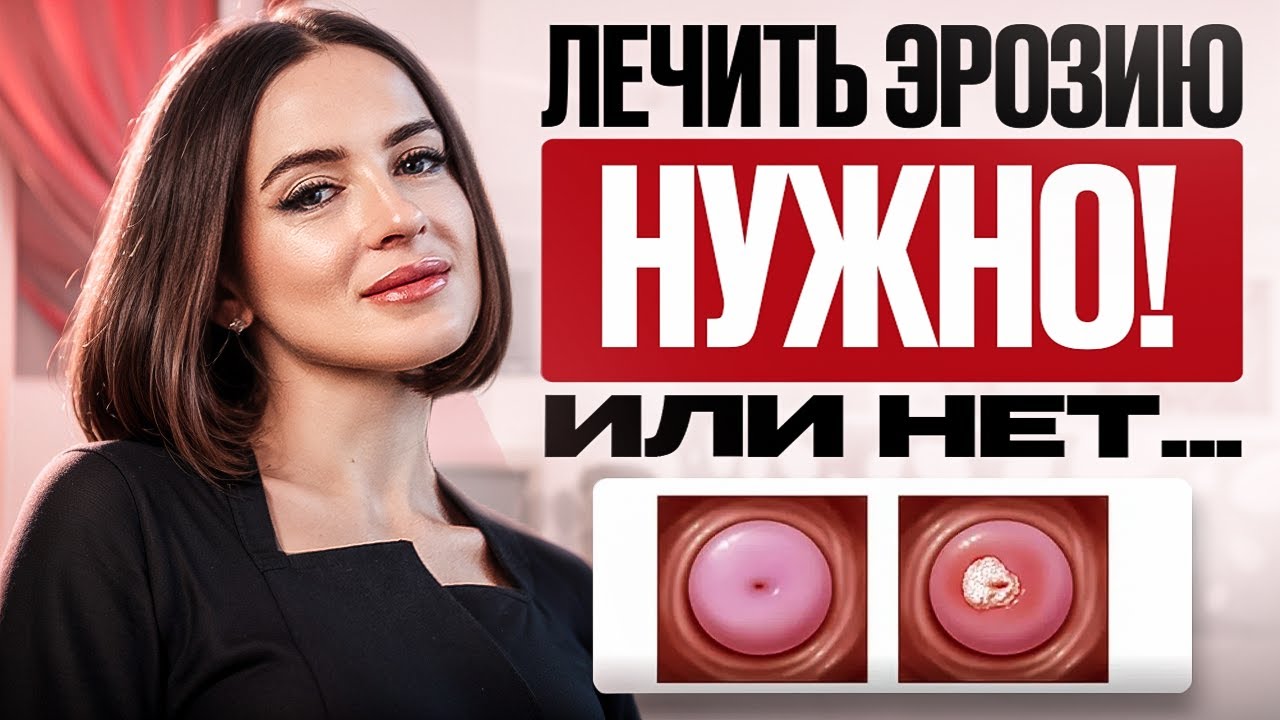 Эрозия шейки матки &mdash; это ОПАСНО? Врачи не всегда говорят ВАМ правду!
