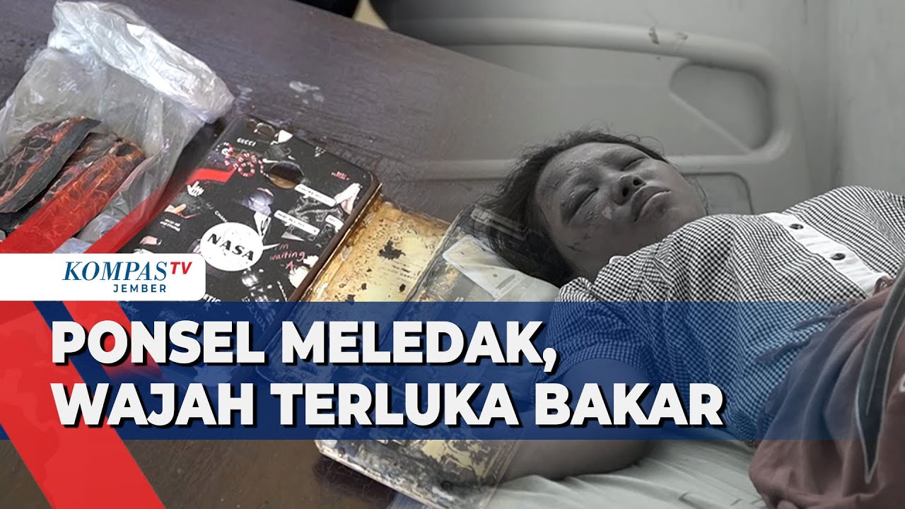 Ponsel Meledak, Wajah Siswi SMK Terluka Bakar