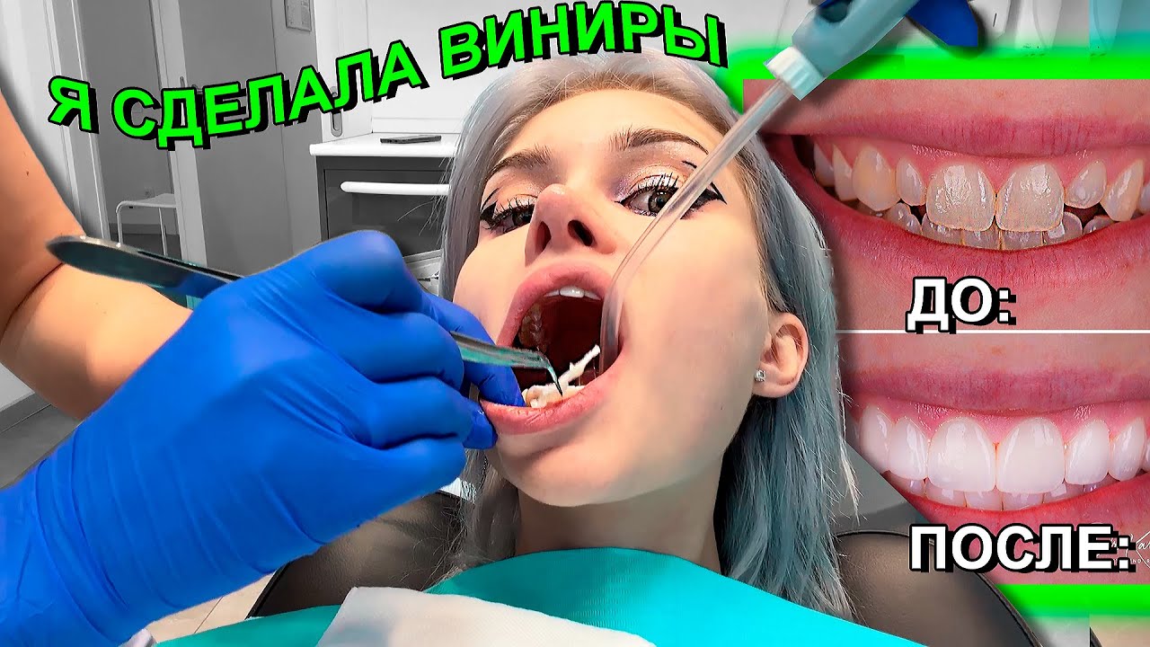 Я СДЕЛАЛА ВИНИРЫ 🦷 ДОРОГО И БОЛЬНО