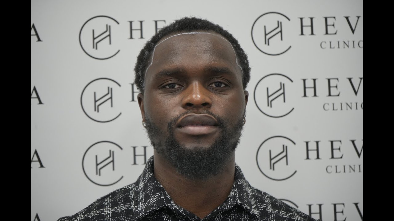 My 5,000 Mile Journey to Heva Clinic for a Hair Transplant | My Self-Improvement Story
