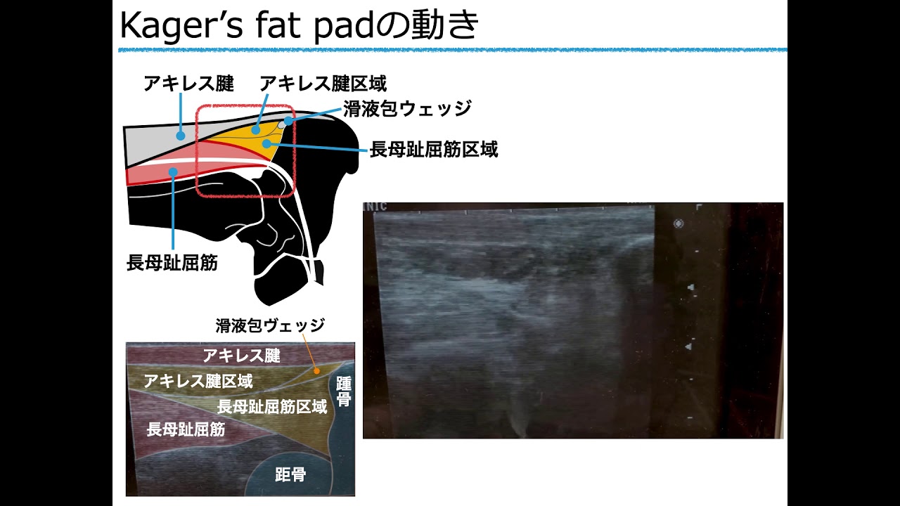 Kager's fat padの動き