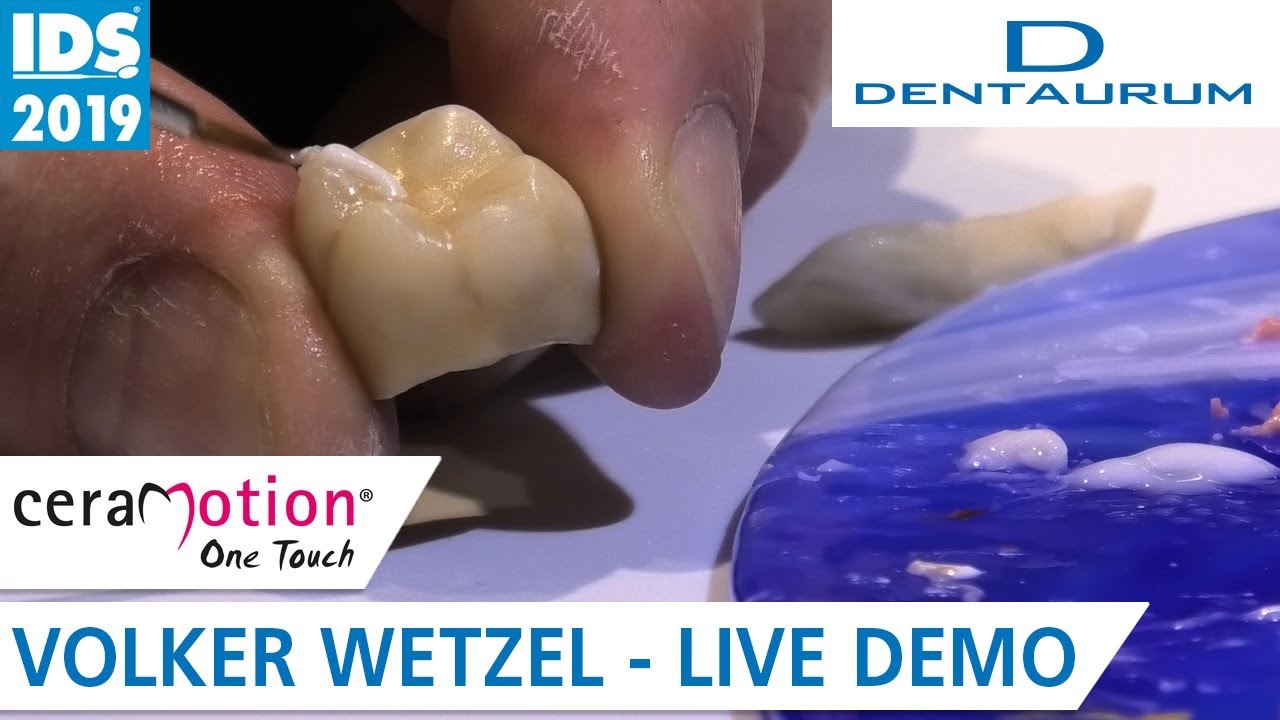 Einfache und Ästhetische Finalisierung mit ceraMotion® One Touch I IDS 2019