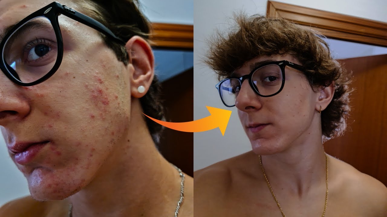 Como Eliminé el Acné (Mi Mayor Miedo)