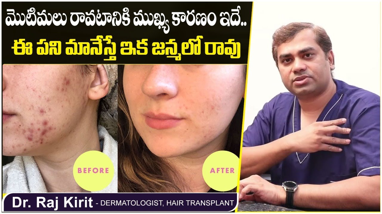మొటిమలకు కారణం | How to Get Rid of Pimples Fast in Telugu | Motimalu | Celestee Skin And Hair Clinic