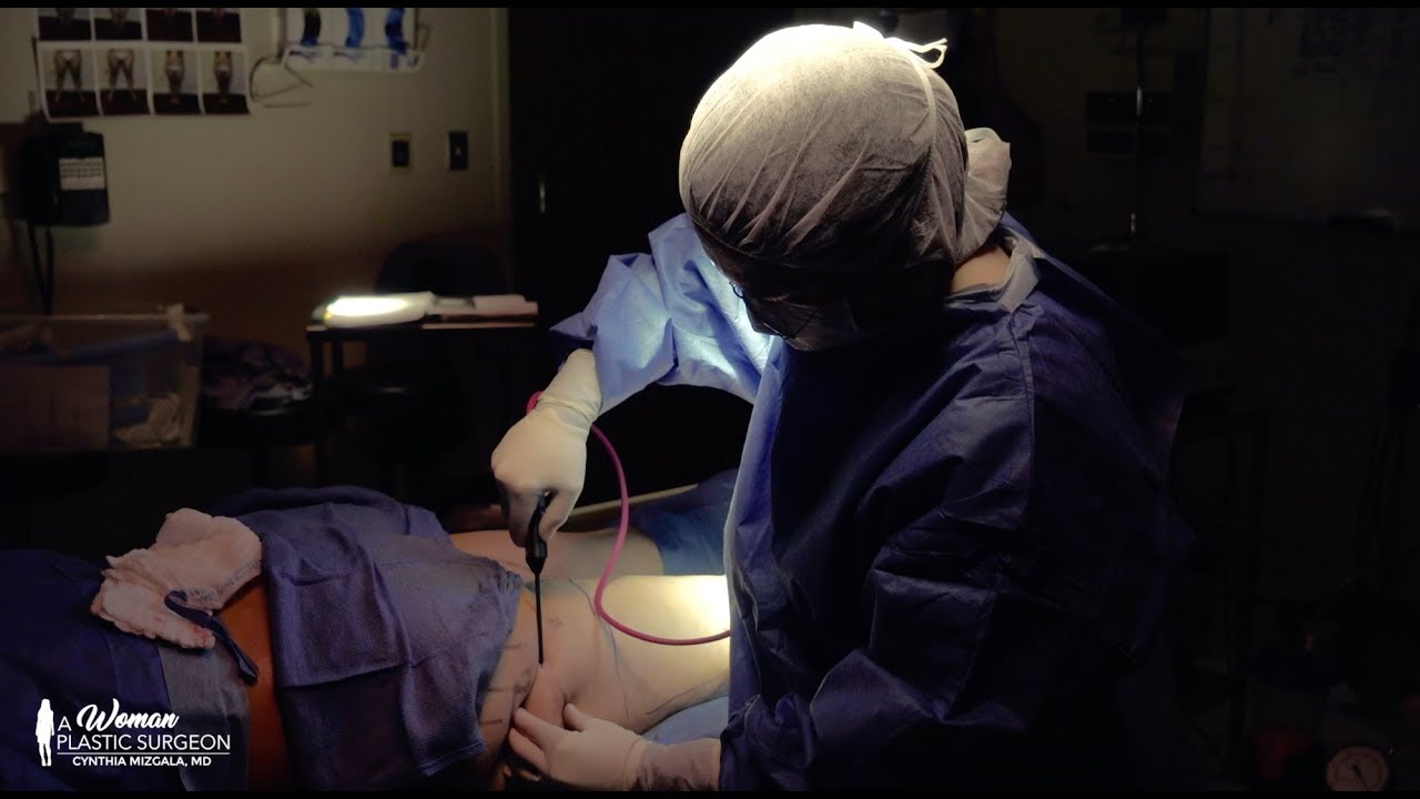 A Woman Plastic Surgeon - Renuvion Procedure Overview