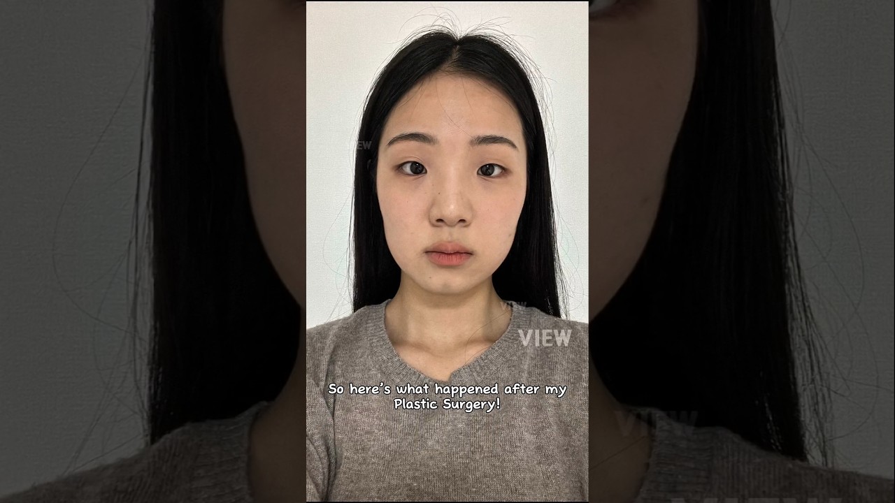 Korean Plastic Surgery Review:  Rhinoplasty, Facial Contouring, Double Eyelid Surgery #nosejobs