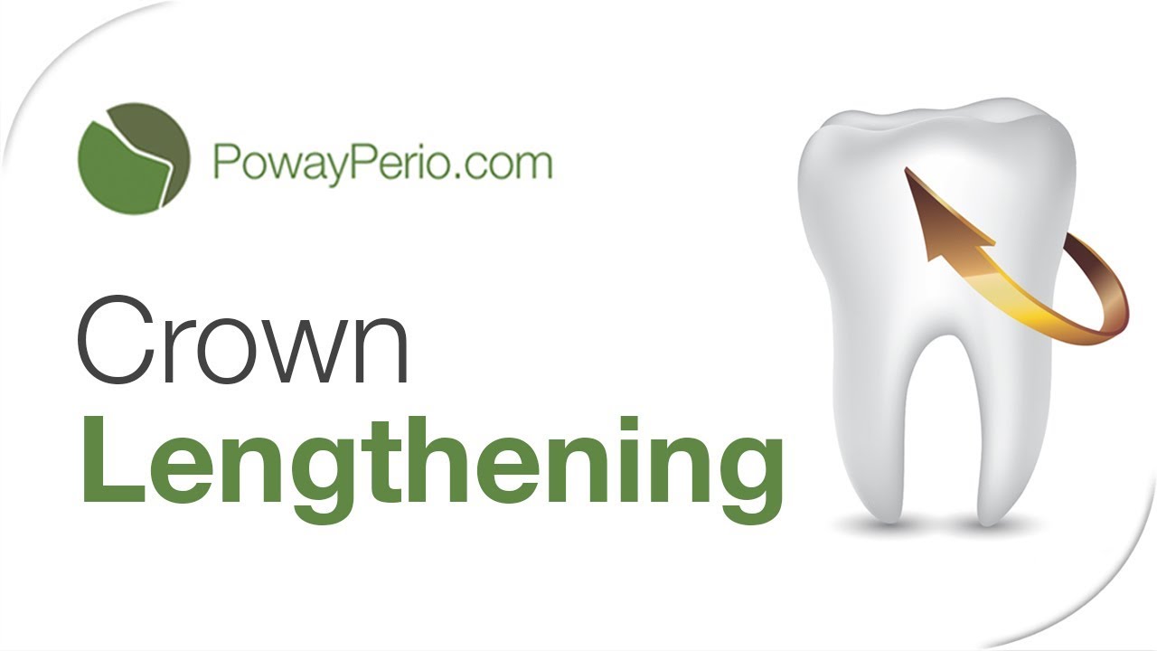 What is a crown lengthening procedure?