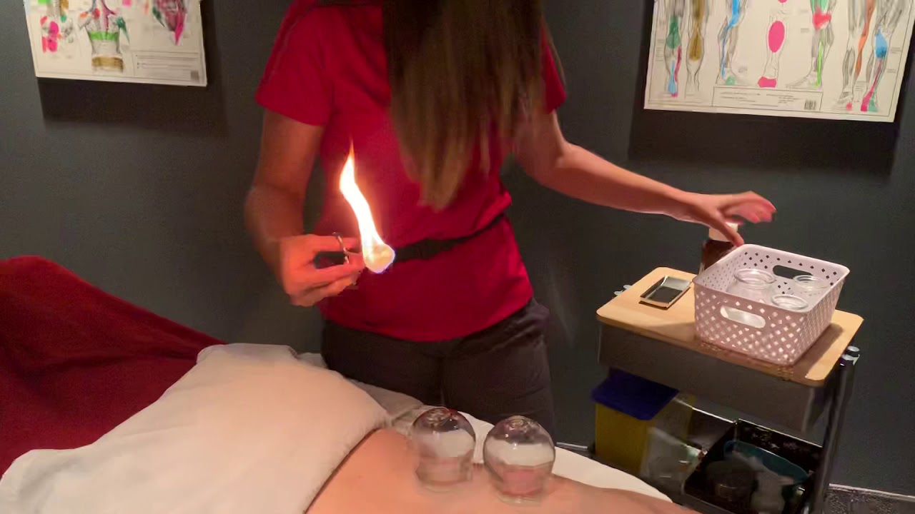 Fire Cupping at Barrie Sports Medicine