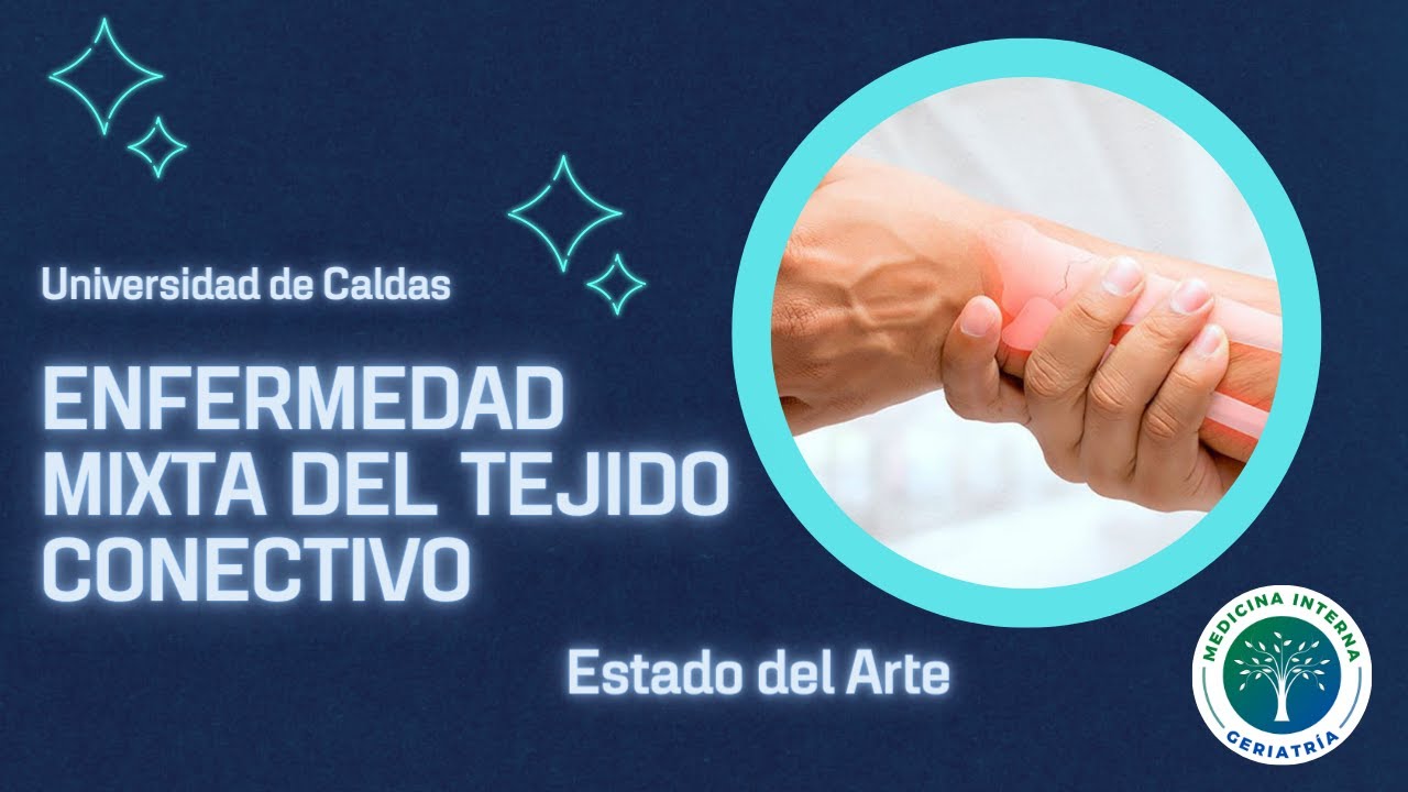 Enfermedad Mixta del Tejido Conectivo Síndrome de Sobreposición en el 2023