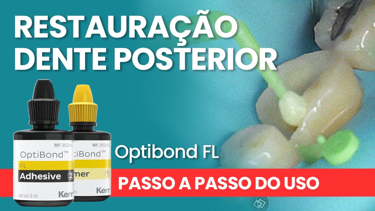 RESTAURAÇÃO DENTE POSTERIOR OPTIBOND FL - Mylene e Renato
