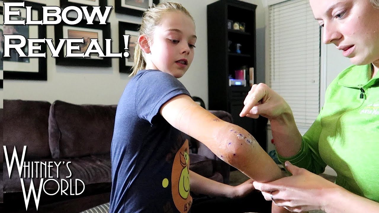 Taking Off the Bandage! | Elbow Surgery | Whitney Bjerken