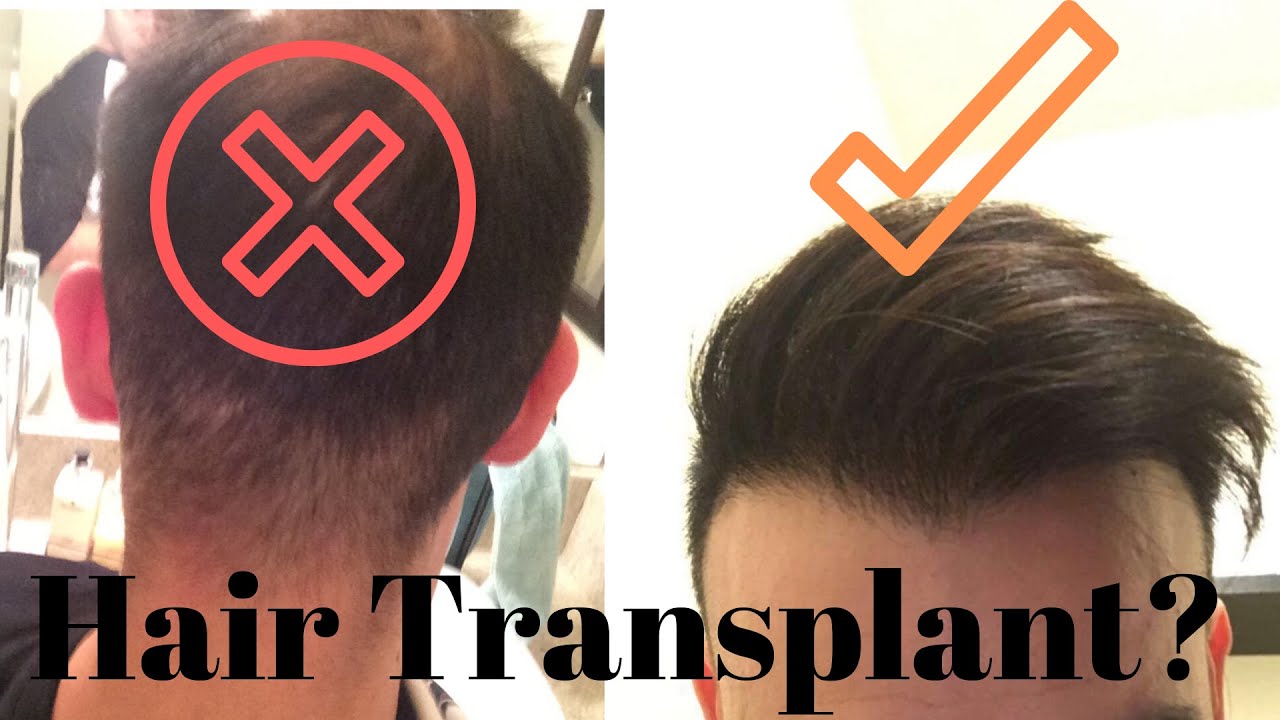 Can You Have A Hair Transplant With Retrograde Alopecia