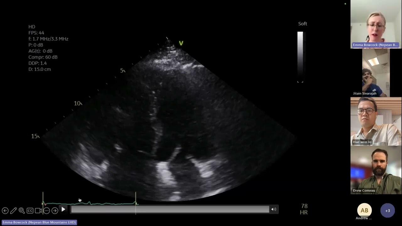 Echo in pulmonary hypertension and consequences to RV PA coupling