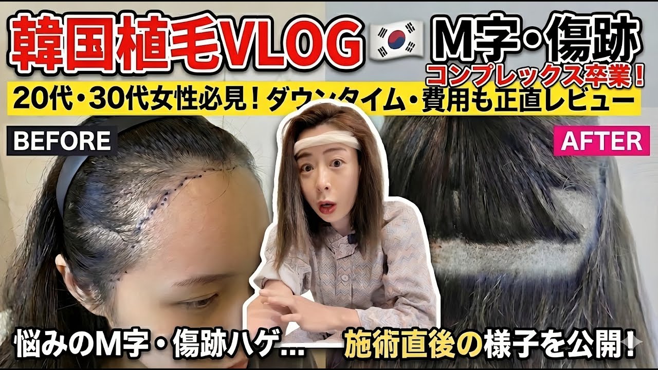 【韓国植毛VLOG】M字・傷跡ハゲを治しに渡韓！植毛したら人生変わった！！！#hairtransformation